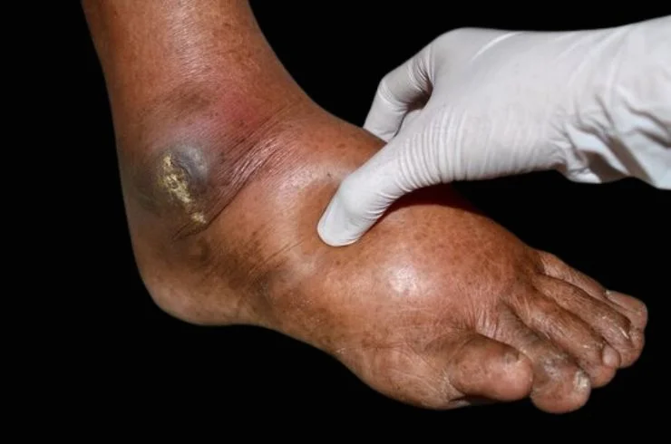 PEDAL EDEMA UNDER EVALUATION 1